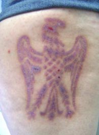healing skin removal scarification