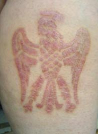 healing skin removal scarification