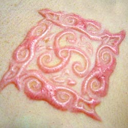 Healed skin removal scarification
