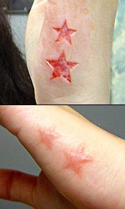 Skin removal scarification by iam:The Fog