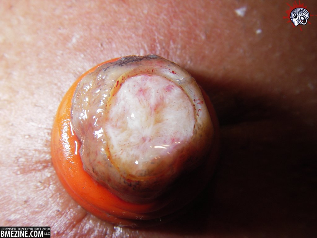 Just after the nipple was removed.