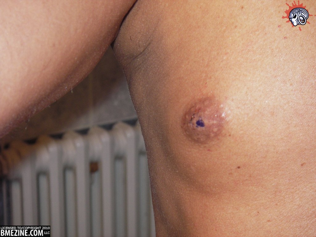 Partially healed