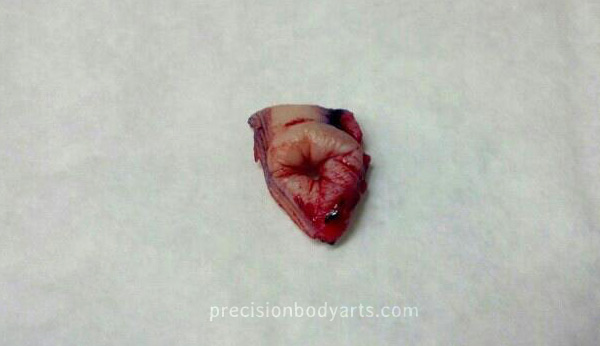 buttholeremoval
