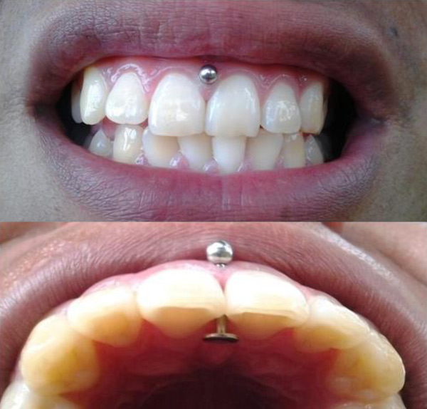 gumpiercing