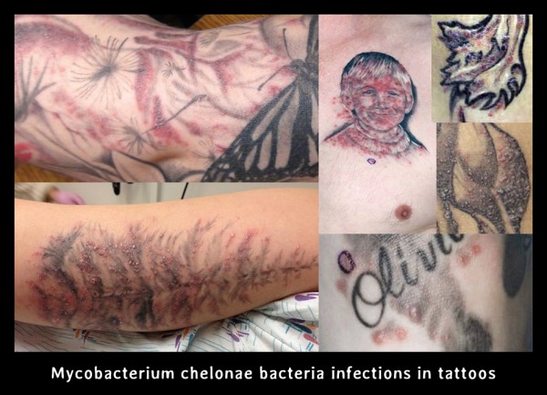 mycoinfections
