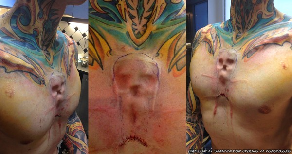 skull-implant