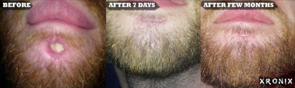 labret-closure