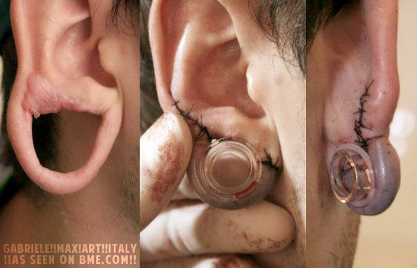 no-more-keloid