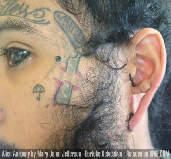 jefferson-earlobe-relocation