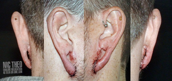 nic-theo-earlobe-relocation-fresh-2