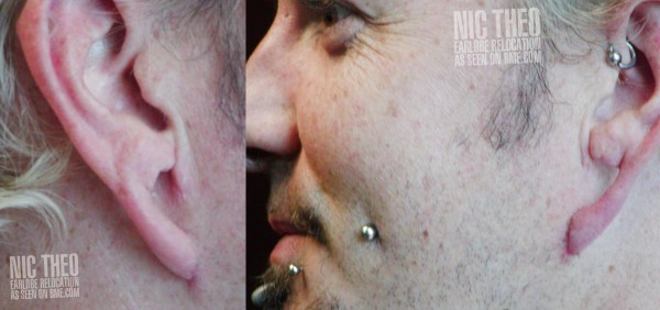 nic-theo-earlobe-relocation-healed