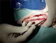 skinring-3t