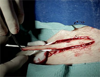 skinring-4t