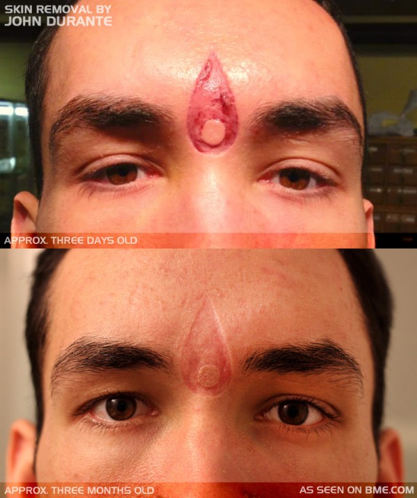 facial-scar-john