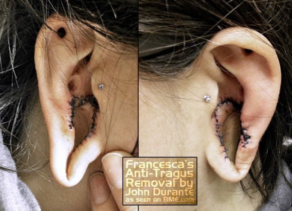 francesca-antitragus-removal