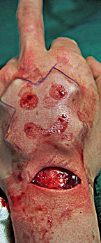 lapis-implant-2t