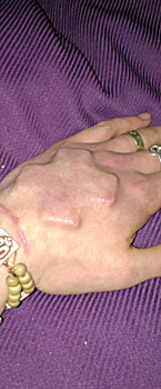 lapis-implant-4t