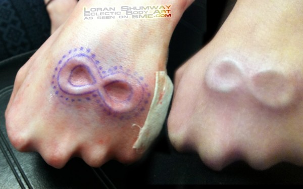 loran-implant