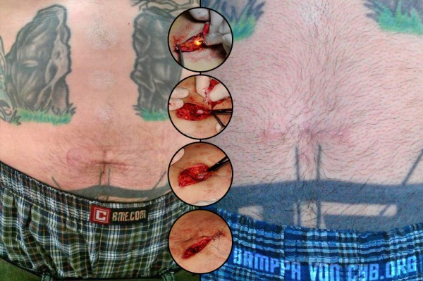 navel-removal