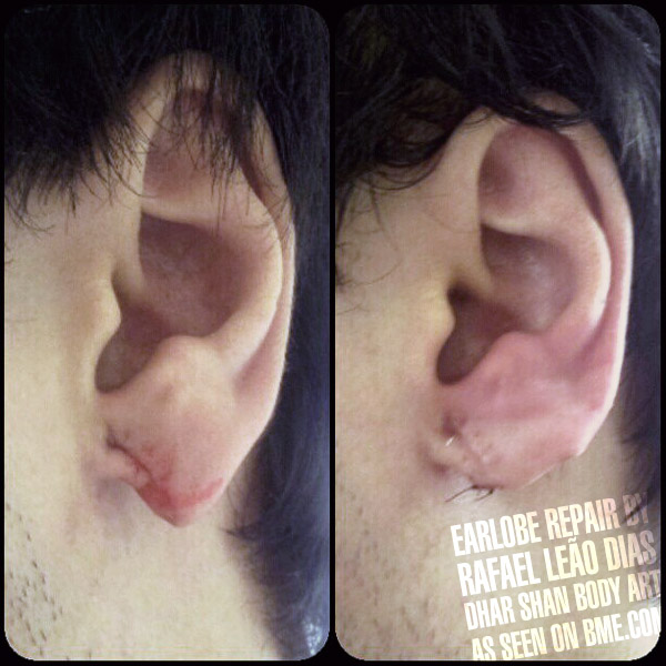 pointy lobe correction