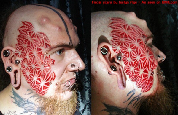 mega facial scar